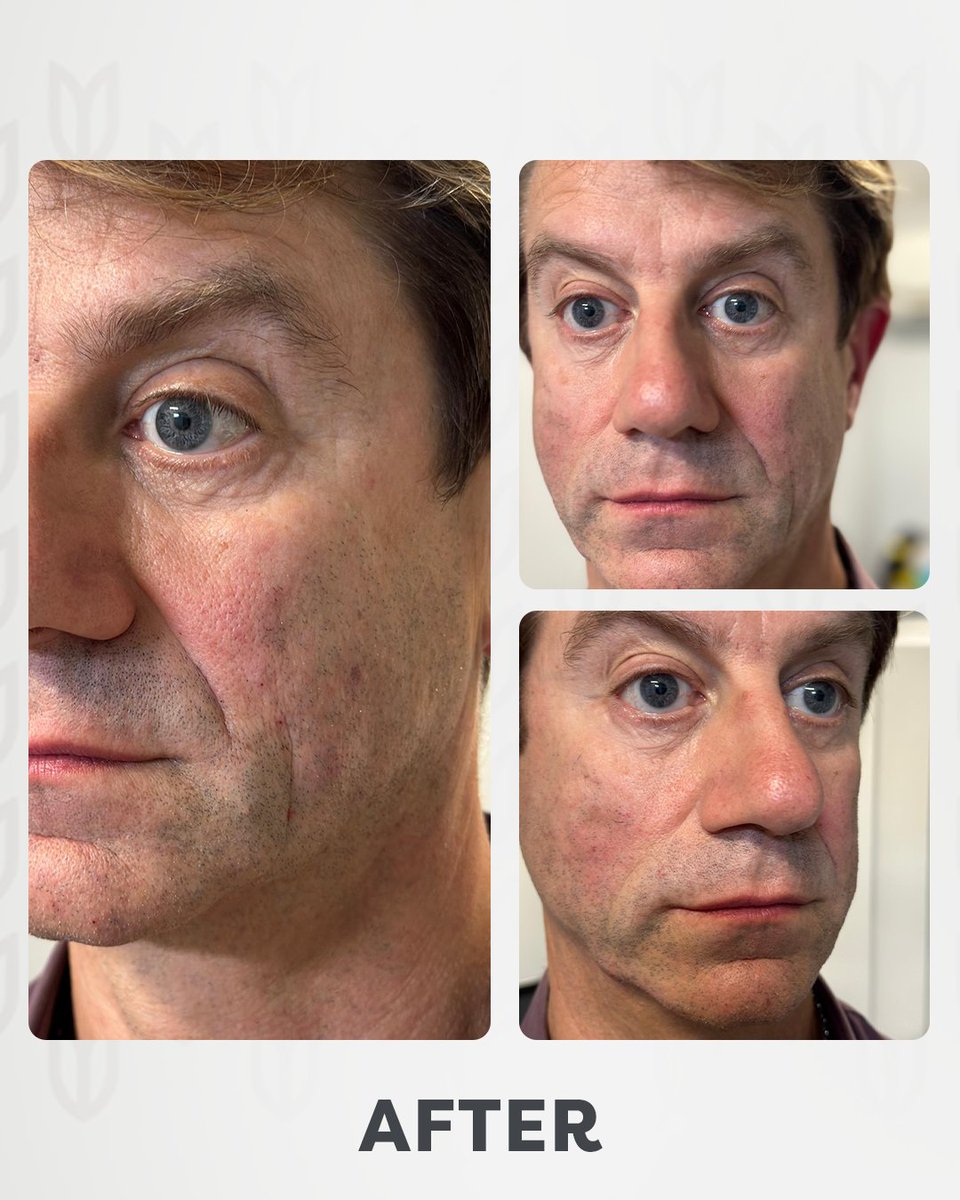 Facial and profile balancing for a refreshed and natural look! ✨
With subtle enhancements, we bring balance and harmony to the face, restoring confidence and youthfulness.
The beauty of non-surgical treatments lies in the natural, yet impactful results. 💉