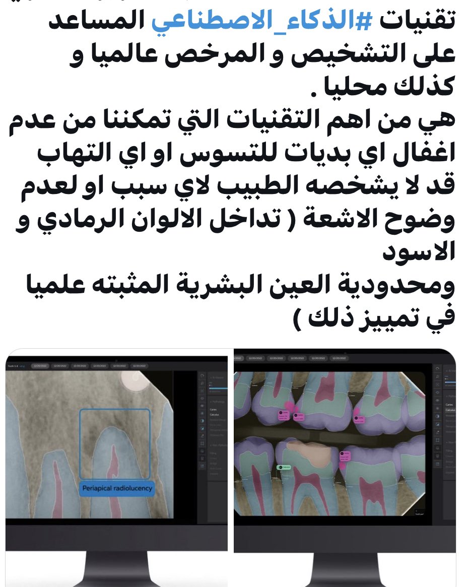 DrAlgufari's tweet photo. تقنيات #الذكاء_الاصطناعي و المعتمده من الهيئات الدوليه (هيئات الدواء والغذاء) اوروبا و امريكا FDA وكذلك المحلية SFDA  
والمرخصة في المساعده على التشخيص ،ستكون من اهم التقنيات الحديثه التي تعطي ثقه للمراجع انه ومن خلال الفحص و الاشعة لم يتم اغفال اي تسوس او التهاب او فقدان للعظم. https://t.co/UQ6azLBbOK