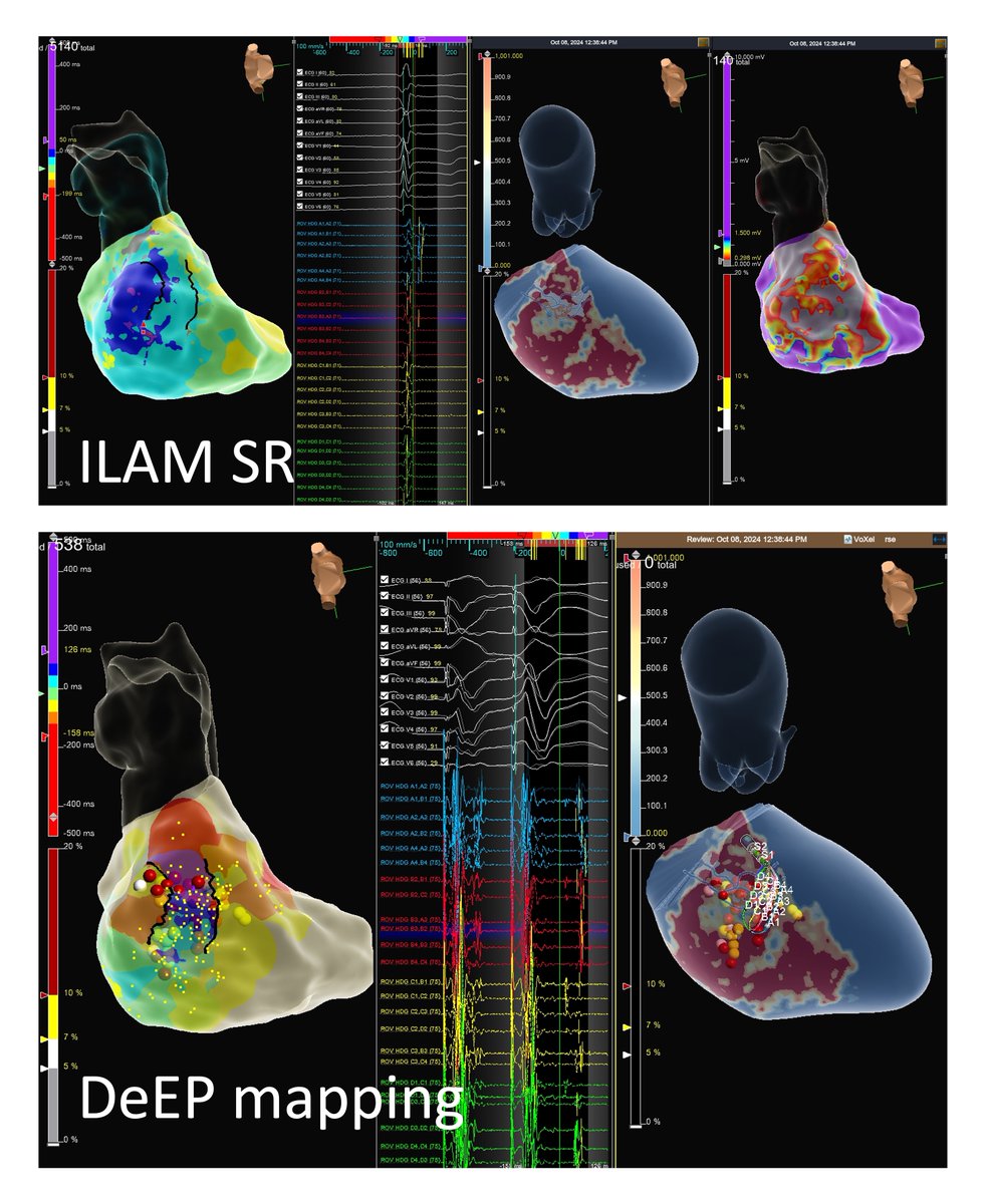 cMRI-aided VT ablation. Perfect match of  MRI corridors with isochronal late activation maps (DeeP mapping).  Minimal lesions with short procedural time (90 min). 
<a href="/SteliosDragasis/">Stelios</a> <a href="/athsaplaouras/">Athanasios Saplaouras</a> <a href="/ipetemil/">Panagiotis Mililis</a>
<a href="/Kariki_O/">Ourania Kariki</a> <a href="/BellosPeriklis/">Periklis Bellos</a> <a href="/eva_nyktari/">Eva Nyktari</a>
<a href="/MEfraimidis/">Michail Efremidis</a> <a href="/ADAS3D/">ADAS3D Medical</a> 
OCSC