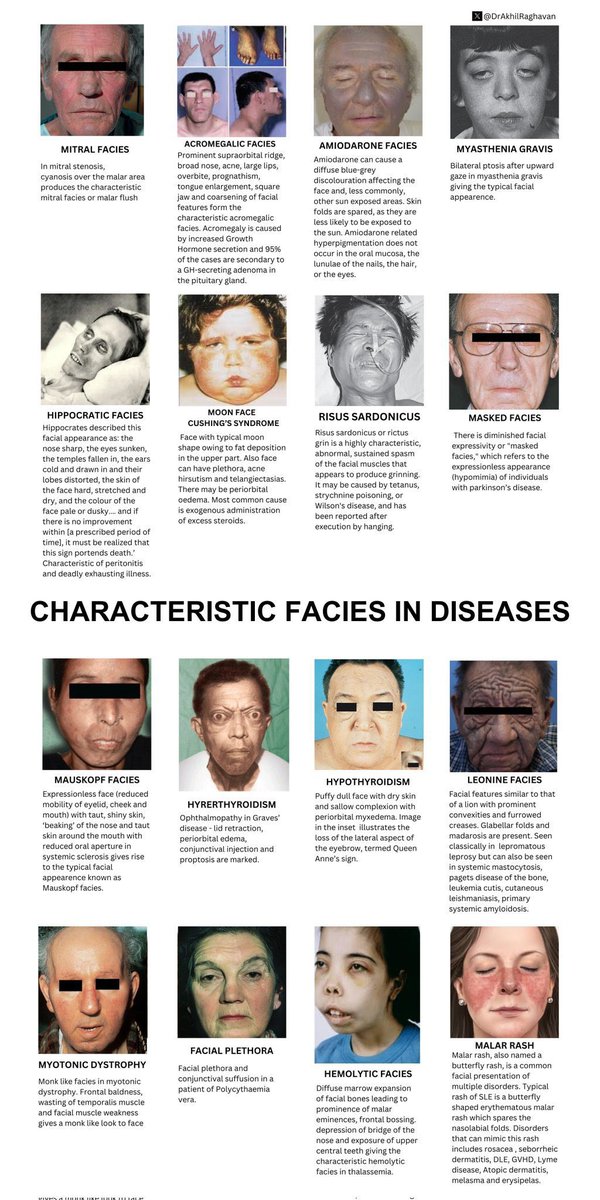 abdulhamid_199's tweet photo. صورة تختصر لك ( Facial appearance) 
لاغلب الامراض اللي راح تواجهك

مفيدة جدا في ال OSCE https://t.co/QOvsgbbrx7