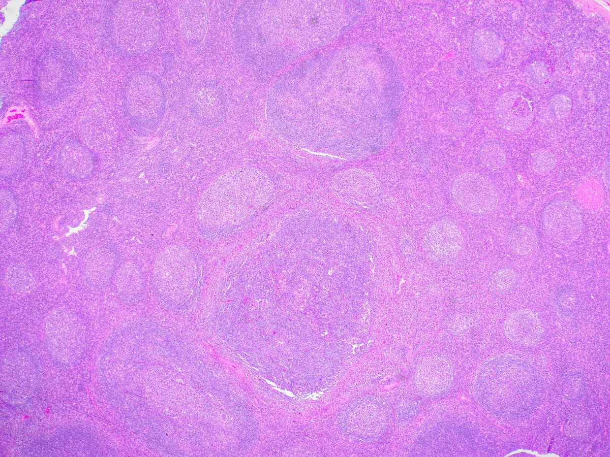 Diagnosis? 

#heme #hemepath #UThealth #hemerotation