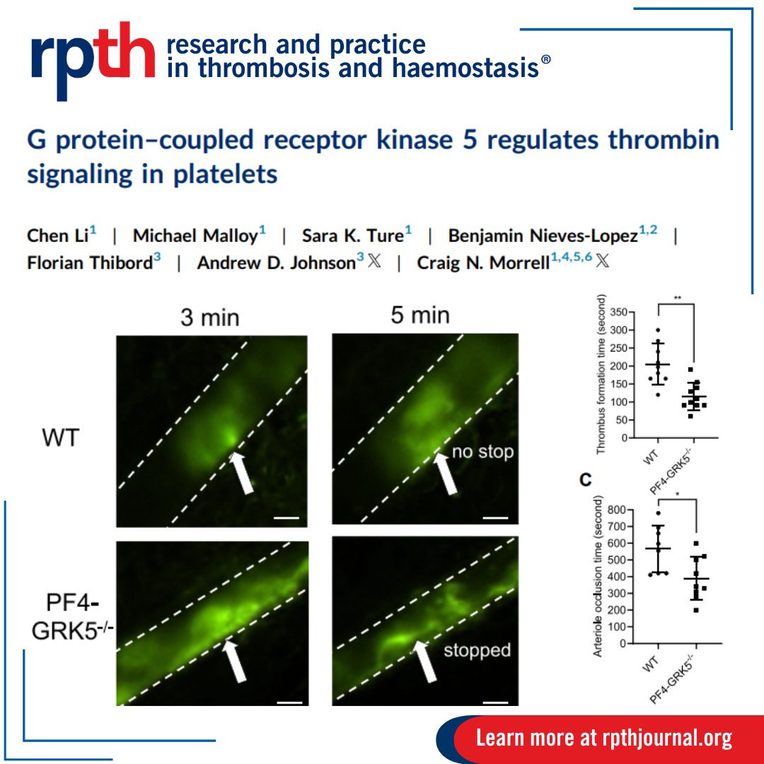 RPTH (@rpthjournal) on Twitter photo 🧬 G protein-coupled receptor kinase 5 (GRK5) variant linked to #platelet reactivity and thrombin response. New study shows platelet-specific GRK5 mutants increase pulmonary embolism risk. <a href="/ADJomics/">Andrew Johnson</a> <a href="/CraigMorrell5/">Craig Morrell</a>
<a href="/ELShematology/">Elsevier Hematology</a>
Learn more: rpthjournal.org/article/S2475-… 🧬 G protein-coupled receptor kinase 5 (GRK5) variant linked to #platelet reactivity and thrombin response. New study shows platelet-specific GRK5 mutants increase pulmonary embolism risk. <a href="/ADJomics/">Andrew Johnson</a> <a href="/CraigMorrell5/">Craig Morrell</a>
<a href="/ELShematology/">Elsevier Hematology</a>
Learn more: rpthjournal.org/article/S2475-…