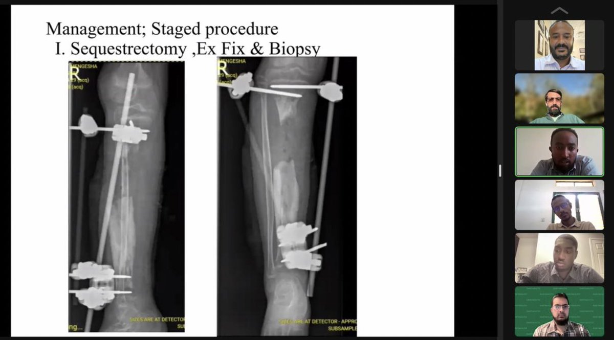 Thank you to the 300+ attendees and fantastic faculty who joined our session today on pediatric chronic #osteomyelitis! Great cases &amp; insightful discussion on managing this complex condition.

Watch here: youtu.be/e4v8LVczYx4?si…

See you next week for Primary Bone Tumors!