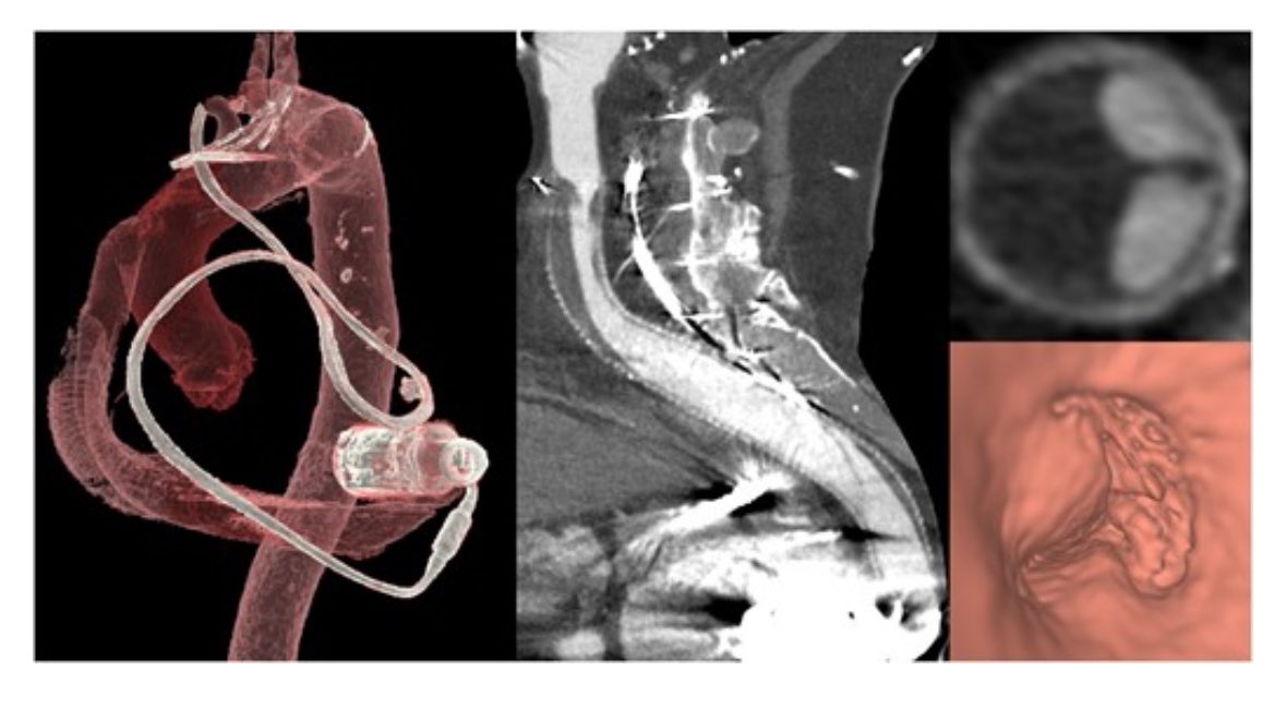 EHJCVI Editor-in-Chief (@ehjcvieic) on Twitter photo Multimodality imaging for the evaluation and management of patients with long-term (durable) LVAD devices - #EACVI clinical consensus document <a href="/s_e_petersen/">Steffen Petersen</a> <a href="/Matte_Cameli/">Matteo Cameli, MD, PhD</a> <a href="/EchoSoliman/">Hatem Soliman, FRCP, FEACVI, FASE, FHEA</a> @MadalinaGarbi <a href="/DrGEMandoli/">Giulia Elena Mandoli, MD, PhD, FESC, FISC</a> ➡️ academic.oup.com/ehjcimaging/ar… <a href="/ESC_Journals/">European Society of Cardiology Journals</a> <a href="/bernhard_gerber/">Bernhard Gerber</a> Multimodality imaging for the evaluation and management of patients with long-term (durable) LVAD devices - #EACVI clinical consensus document <a href="/s_e_petersen/">Steffen Petersen</a> <a href="/Matte_Cameli/">Matteo Cameli, MD, PhD</a> <a href="/EchoSoliman/">Hatem Soliman, FRCP, FEACVI, FASE, FHEA</a> @MadalinaGarbi <a href="/DrGEMandoli/">Giulia Elena Mandoli, MD, PhD, FESC, FISC</a> ➡️ academic.oup.com/ehjcimaging/ar… <a href="/ESC_Journals/">European Society of Cardiology Journals</a> <a href="/bernhard_gerber/">Bernhard Gerber</a>