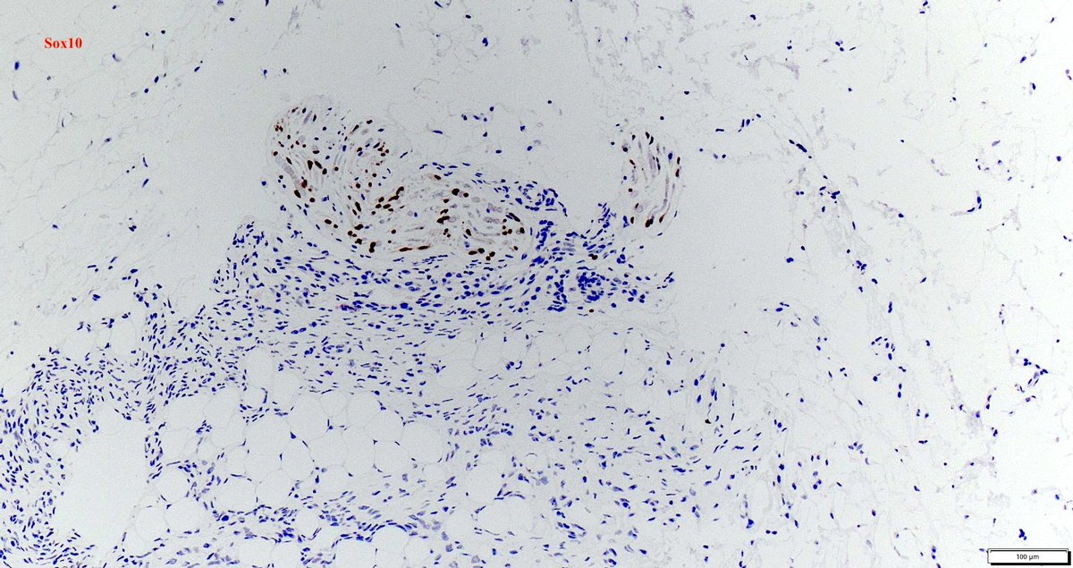 Dermatofibrosarcoma protuberans (DFSP) with a typical honeycomb appearance. This one shows entrapment of a few nerves (largest 0.3 mm), otherwise classic DFSP. Diffusely positive for CD34 (image not shown). #dermpath #PathTwitter #PathX #BSTpath