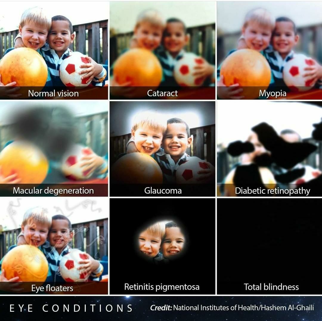 MoarSahitoPTI's tweet photo. Various eye conditions. 👁 https://t.co/8ilFwEu1hZ