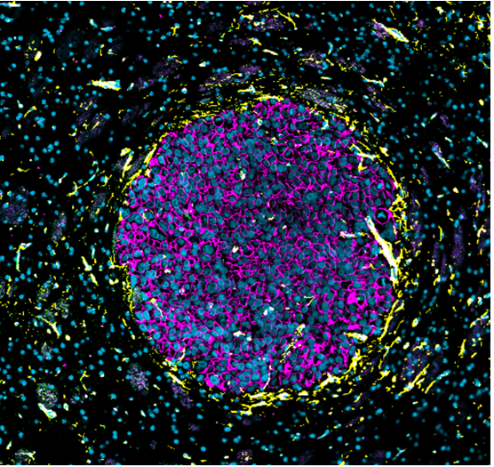 Molecular Breast Pathology Lab (@breast_lab) on Twitter photo #Metastatic #BreastCancerAwarenessDay 🎀
🧠Did you know #breastcancer can sometimes spread to the brain? 
Our lab investigates how #BrainMetastases form, with the goal of finding new therapeutic targets to improve treatment 🔬🧫
#BreastCancerAwarenessMonth #UQCCR #Metastatic #BreastCancerAwarenessDay 🎀
🧠Did you know #breastcancer can sometimes spread to the brain? 
Our lab investigates how #BrainMetastases form, with the goal of finding new therapeutic targets to improve treatment 🔬🧫
#BreastCancerAwarenessMonth #UQCCR