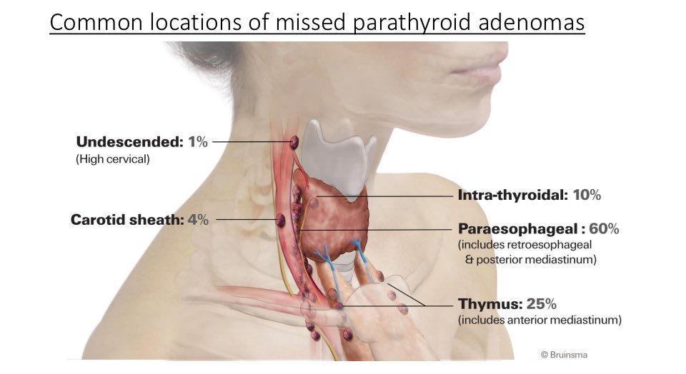 Michael Yeh (@michaelyehmd) on Twitter photo For those interested, Iāll be giving a session on difficult parathyroid surgery at #ACSCC24 on Monday 10/21 with <a href="/DrNancyPerrier/">Nancy Perrier</a>. <a href="/AmCollSurgeons/">American College of Surgeons</a>
Details here: abstractsonline.com/pp8/#!/10972/s⦠For those interested, Iāll be giving a session on difficult parathyroid surgery at #ACSCC24 on Monday 10/21 with <a href="/DrNancyPerrier/">Nancy Perrier</a>. <a href="/AmCollSurgeons/">American College of Surgeons</a>
Details here: abstractsonline.com/pp8/#!/10972/sā¦