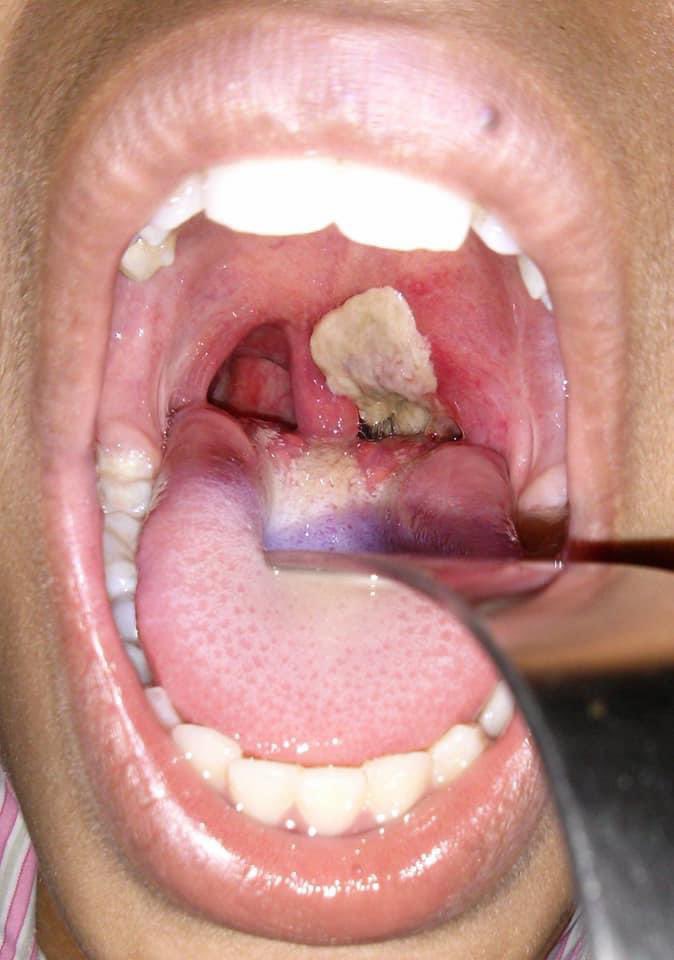 Medicinemadeasy's tweet photo. #diptheria #pseudomembrane #bullneck
#MedX #MedTwitter #medicine https://t.co/huXmgVrPLW
