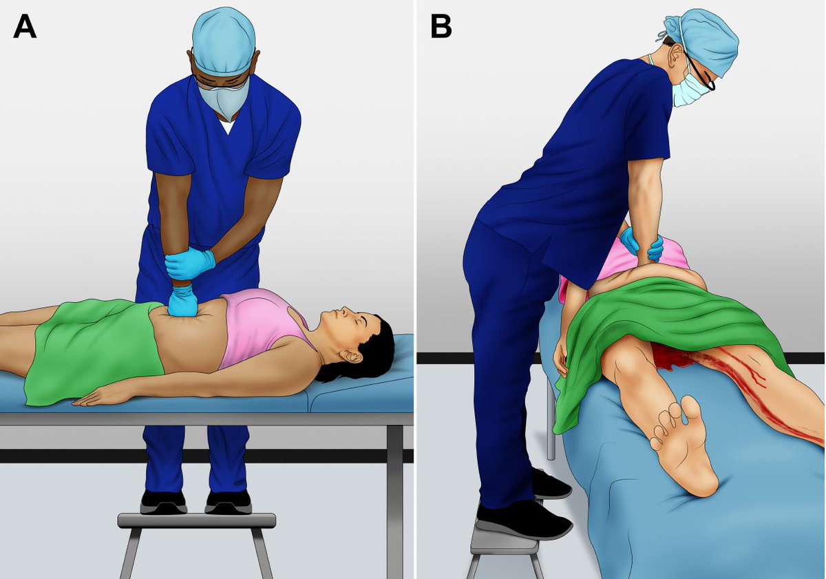 AJOG Surgeon's Corner:  External aortic compression: buying time to save lives in obstetric hemorrhage: External Aortic Compression for the Control of Obstetric Hemorrhage. A. Frontal View and B. Lateral View of External Manual Aortic Compression ow.ly/2me350TKjs2