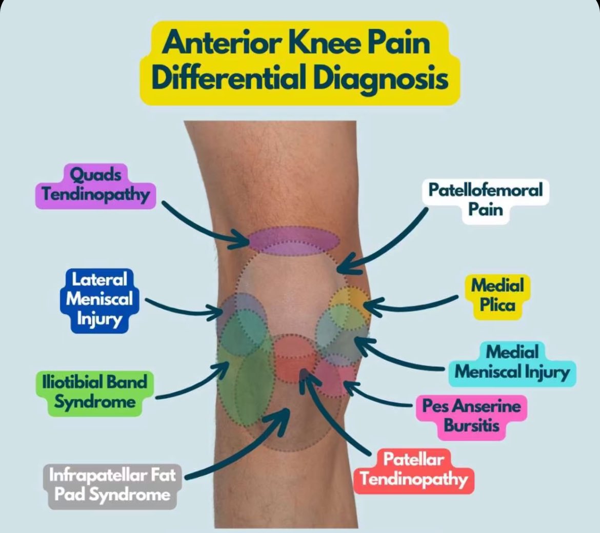 PTstep_'s tweet photo. Knee joint 

كل مكان يشير إلى مسبب معين
هنا صورة تقريبية توضح الركبة من الأمام والالآم  المرتبطة بكل مسبب🦵🏻 https://t.co/9QdcmW4PVH