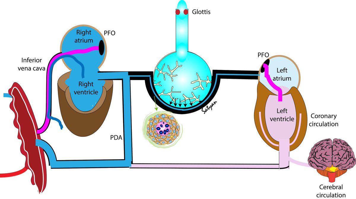 neosatyan's tweet image. Dear #neotwitter and @AAPneonatal - based on a request from some colleagues, I will start posting a #Neographic every Sunday with minimal text so that you can use these figures for your PowerPoint slides. Starting with a simple figure of fetal circulation &amp;amp; PPHN heart @songMD