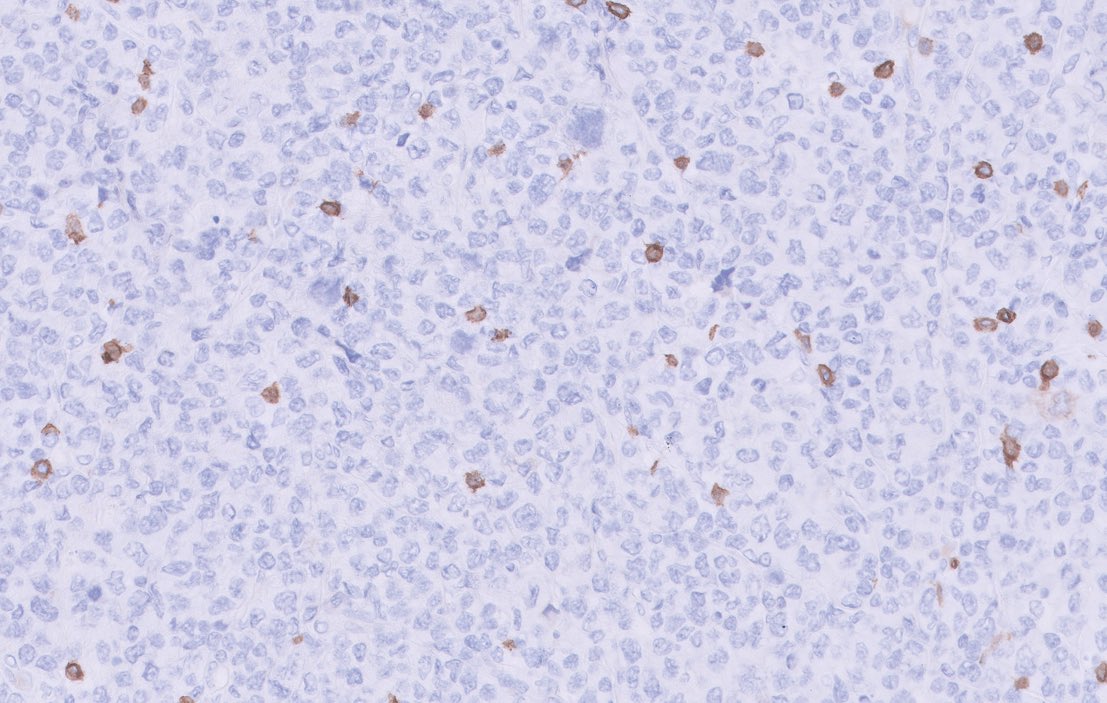 Neck LN excision 51 yo male with generalized LAD with high PET avidity. Attached here the H&amp;E and CD20 and CD3. Also negative: CD79a, PAX5, OCT2, BOB1, CD38, CD138. See comments for additional stains and diagnosis 🙈