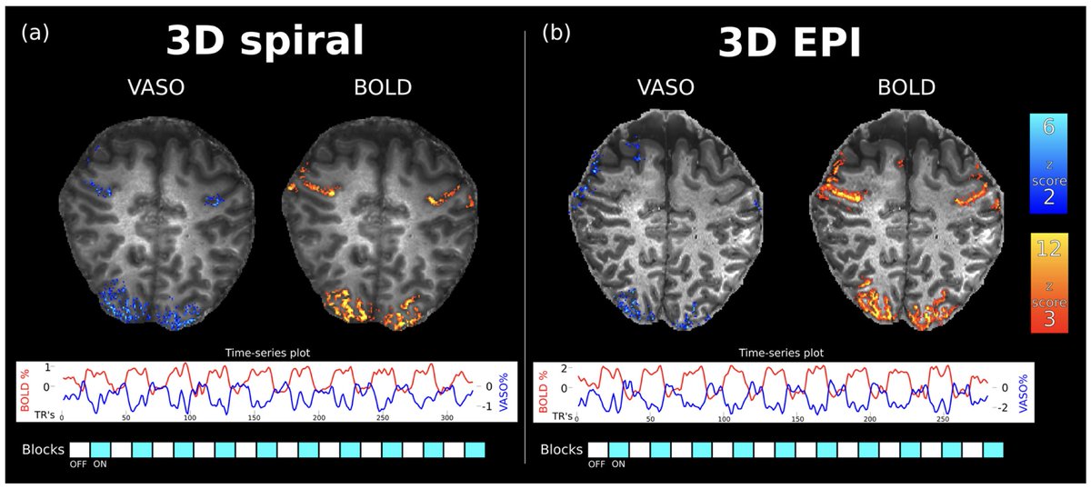ImagingNeurosci's tweet photo. New paper in Imaging Neuroscience by Alejandro Monreal-Madrigal, Benedikt A. Poser, et al:

Combining the benefits of 3D acquisitions and spiral readouts for VASO fMRI at UHF

https://t.co/AZfjVzkN1V https://t.co/d2KwmxRAPk