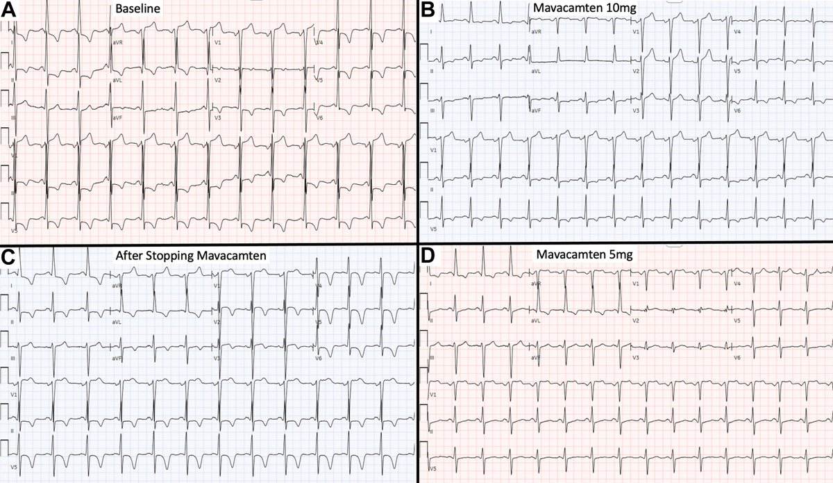 JACC Journals (@jaccjournals) on Twitter photo In this new #JACCCaseReports Clinical Vignette Corner, Dr. <a href="/MelissaAustinMD/">Melissa Austin, MD</a>, et al discuss a case of a 60 y/o man w/ #cvHCM treated with the novel cardiac myosin inhibitor, mavacamten bit.ly/4gXqtKj
<a href="/noshreza/">Nosheen Reza, MD, MS</a> <a href="/tikuowens/">Anjali Owens</a> In this new #JACCCaseReports Clinical Vignette Corner, Dr. <a href="/MelissaAustinMD/">Melissa Austin, MD</a>, et al discuss a case of a 60 y/o man w/ #cvHCM treated with the novel cardiac myosin inhibitor, mavacamten bit.ly/4gXqtKj
<a href="/noshreza/">Nosheen Reza, MD, MS</a> <a href="/tikuowens/">Anjali Owens</a>