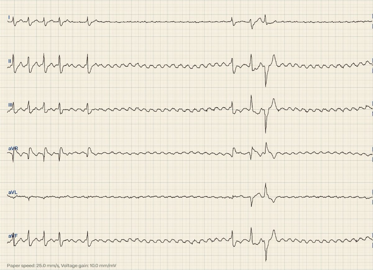 ecgandrhythmRoe's tweet image. After administering Adensin i.v. to terminate a tachycardia you see this ECG: What is the rhythm?