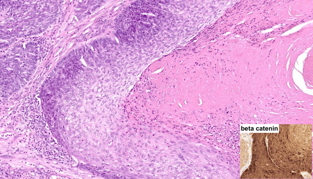 A case of matrical carcinoma, the malignant counterpart of pilomatricoma, characterized by the presence of ghost cells👻and β-catenin nuclear-membranous positivity in basaloid cells (negative in transitional and ghosts) #pathology #dermpath #dermatology #MedX #PathX #dermatologia