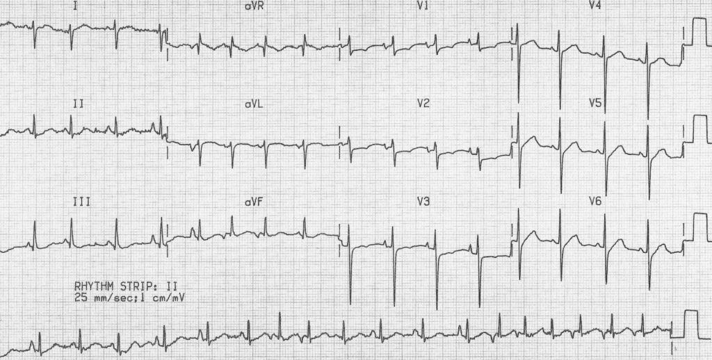 اجاك مريض كبير بالعمر يدخن وعنده وضيق نفس وهيك ال ECG تبعه
شو اول شي ييجي بعقلك وشو اول خطوة بتاخذها بعد هيك؟
الصعوبة: متوسطة