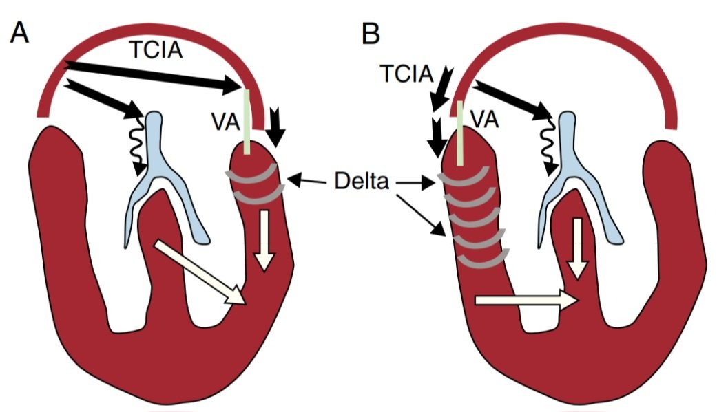 javier20ch's tweet photo. 🟥Preexcitación ventricular: derecha ó izquierda. 🤔🧐🔎🫀⚡️
🔶️La conducción en el nodo AV es lenta y en la vía accesoria es rápida (preexcitación). La mayoría de las vías accesorias son de ubicación izquierda (70-80%), el resto son vías derechas (10-20%) ó de múltiples vías (<10%). 📊⚡️🫀
🔶️La cantidad de miocardio ventricular activado a través de la vía accesoria (preexcitado) es mayor en las vías derechas que en las izquierdas por el solo hecho de que el tiempo de conducción desde el nodo sinusal a la inserción auricular de la vía accesoria es menor (mayor proximidad). ⚡️🫀
🔶️En las vías derechas la preexcitación suele ser más notoria (Complejos QRS >140 ms) por la mayor cantidad de miocardio ventricular activado. 📈⚡️🫀

https://t.co/9n8FZOBIjd