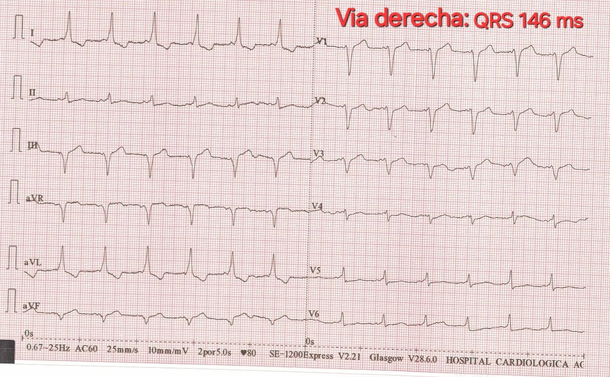 javier20ch's tweet photo. 🟥Preexcitación ventricular: derecha ó izquierda. 🤔🧐🔎🫀⚡️
🔶️La conducción en el nodo AV es lenta y en la vía accesoria es rápida (preexcitación). La mayoría de las vías accesorias son de ubicación izquierda (70-80%), el resto son vías derechas (10-20%) ó de múltiples vías (<10%). 📊⚡️🫀
🔶️La cantidad de miocardio ventricular activado a través de la vía accesoria (preexcitado) es mayor en las vías derechas que en las izquierdas por el solo hecho de que el tiempo de conducción desde el nodo sinusal a la inserción auricular de la vía accesoria es menor (mayor proximidad). ⚡️🫀
🔶️En las vías derechas la preexcitación suele ser más notoria (Complejos QRS >140 ms) por la mayor cantidad de miocardio ventricular activado. 📈⚡️🫀

https://t.co/9n8FZOBIjd