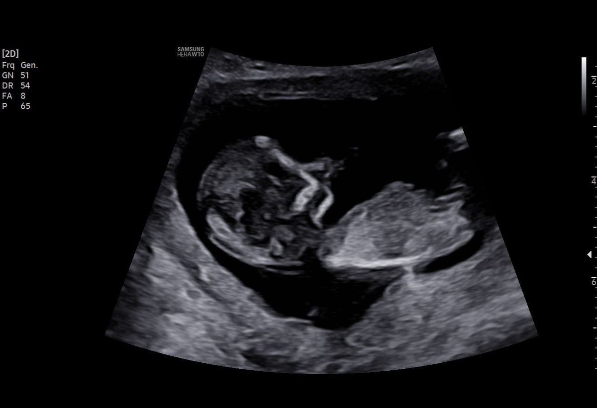 heather9284's tweet photo. @leannrimes @Rendeekay wanted to let you you two know! 🙂❤️
13 weeks as of yesterday 🙂 https://t.co/N3En0ahJRN