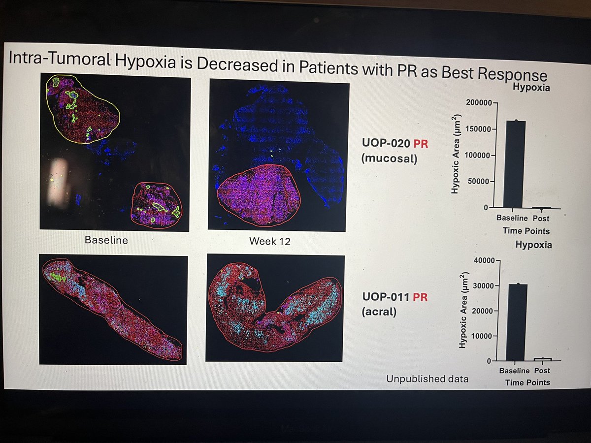 Yana Najjar (@yananajjarmd) on Twitter photo I was delighted to present our translationally driven study at #SMR24 today. By reducing intra tumoral hypoxia, we see high rates of disease control in heavily pre-treated patients with #acral and #mucosal #melanoma. <a href="/SocietyMelanoma/">Society For Melanoma Research</a> <a href="/DelgoffeLab/">Delgoffe Lab</a> I was delighted to present our translationally driven study at #SMR24 today. By reducing intra tumoral hypoxia, we see high rates of disease control in heavily pre-treated patients with #acral and #mucosal #melanoma. <a href="/SocietyMelanoma/">Society For Melanoma Research</a> <a href="/DelgoffeLab/">Delgoffe Lab</a>