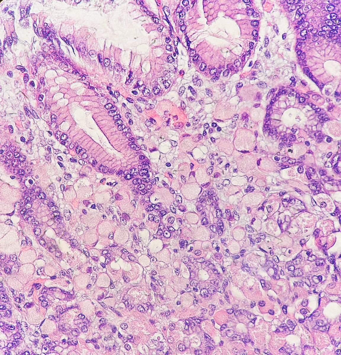 Path4People's tweet photo. #pathtip

Stomach, at low power, identify areas of fibrosis or where lamina propria is edematous, then look closer. 

Can you see the signet ring 💍 cells? 

#pathx #gipath #pathtwitter #pathology #medx #hemeonc #pathagonia #path4people #gastriccancer https://t.co/ORGnfR0z7x