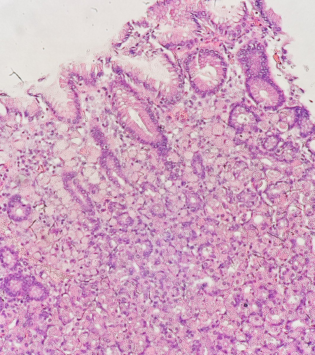 Path4People's tweet photo. #pathtip

Stomach, at low power, identify areas of fibrosis or where lamina propria is edematous, then look closer. 

Can you see the signet ring 💍 cells? 

#pathx #gipath #pathtwitter #pathology #medx #hemeonc #pathagonia #path4people #gastriccancer https://t.co/ORGnfR0z7x