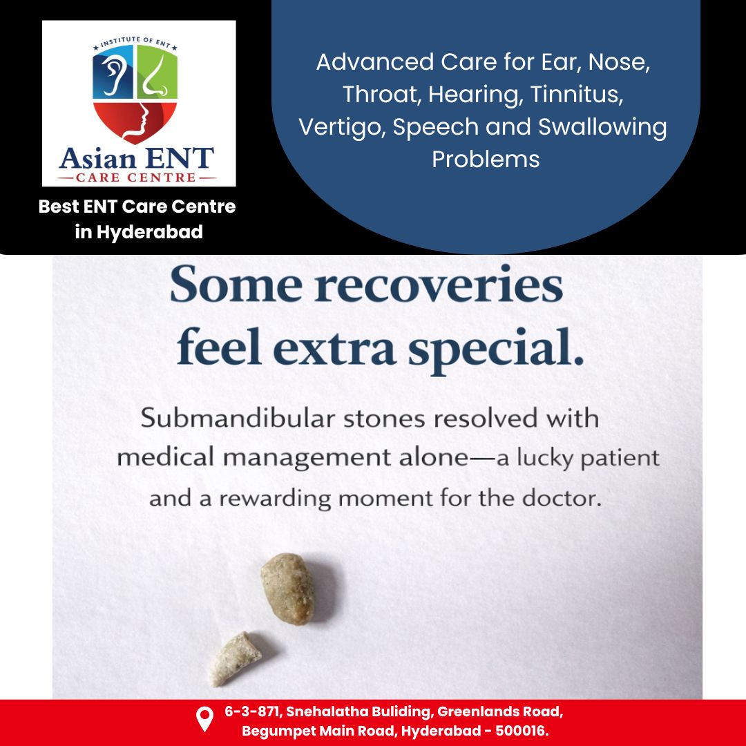 AsianEntCare's tweet photo. Submandibular stones successfully resolved with medical management alone, avoiding surgery.                     📍 Begumpet, Hyderabad                                                          📞 +91 81790 33446 | 80081 8880 https://t.co/6dUkxPl8qZ