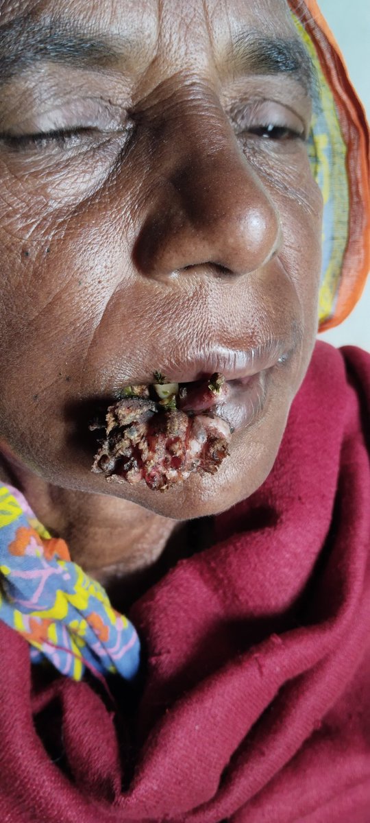 sunil4deep's tweet photo. @hyderabaddoctor @shashiiyengar @whitfieldlewis6 @LorickFoxPA  this is a collapse with iron rod water pump,she came here after 3months for diagnosis.what exact diagnosis? when she eat some puss emit . https://t.co/m5wR6OURwp