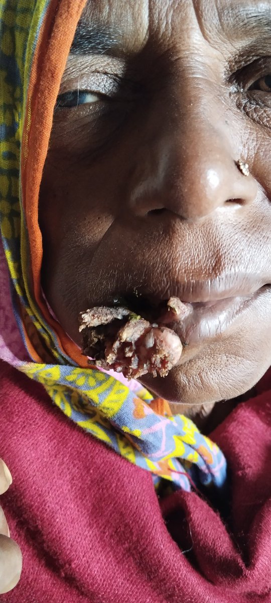 sunil4deep's tweet photo. @hyderabaddoctor @shashiiyengar @whitfieldlewis6 @LorickFoxPA  this is a collapse with iron rod water pump,she came here after 3months for diagnosis.what exact diagnosis? when she eat some puss emit . https://t.co/m5wR6OURwp