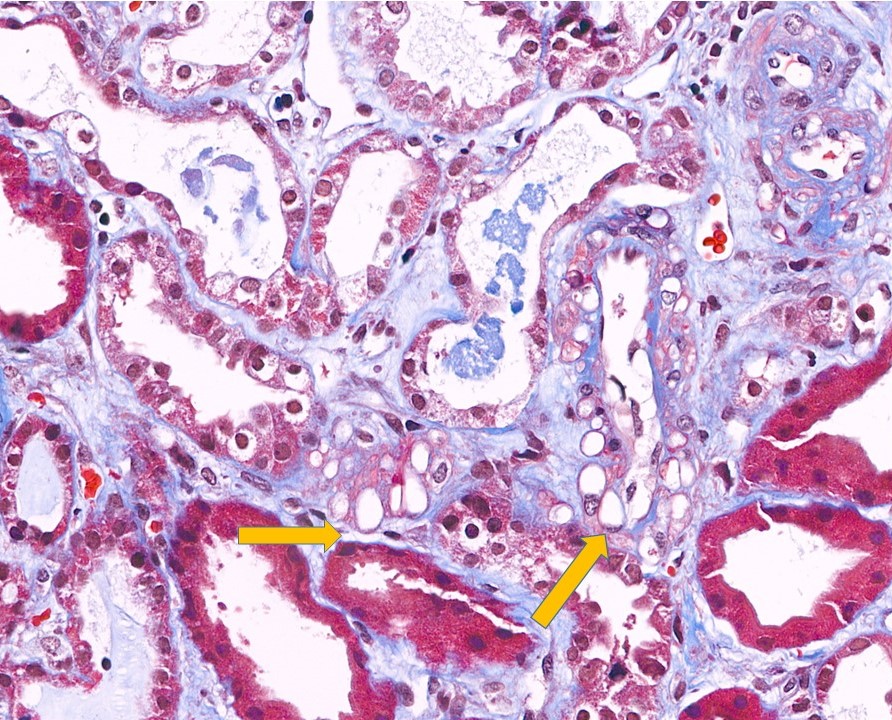 CNI induced early toxic arteriopathy with swelling or ballooning of medial smooth muscle cells