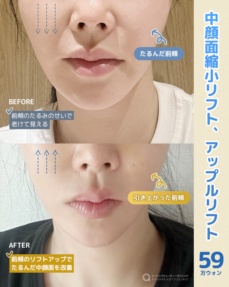 シェイプアップリフト 値引きしました シェイプアップリフト 値引きしました VIP TICKETS ALMOST SOLD OUT