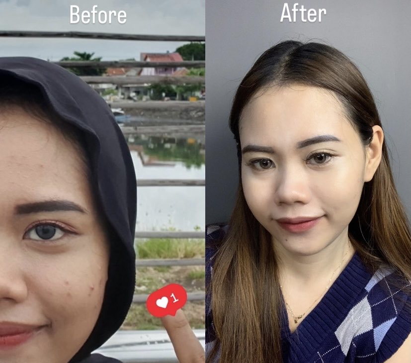 dari yang jerawatan kusam gini jadi bersih begini🫶🏻⬇️