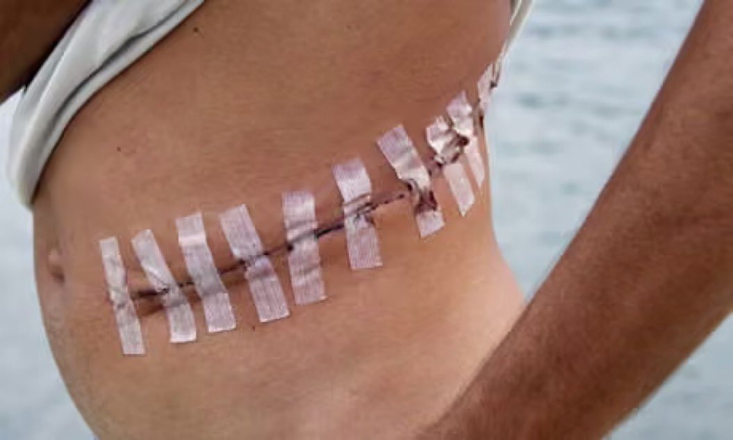 Jvnior's tweet image. 🚨 BREAKING:

Israeli group seeks to set a world record for kidney donations, but human rights reports and forensic findings EXPOSED that organs including hearts, lungs, kidneys, and corneas were removed from Palestinian bodies returned from Israeli custody.

This is demonic.