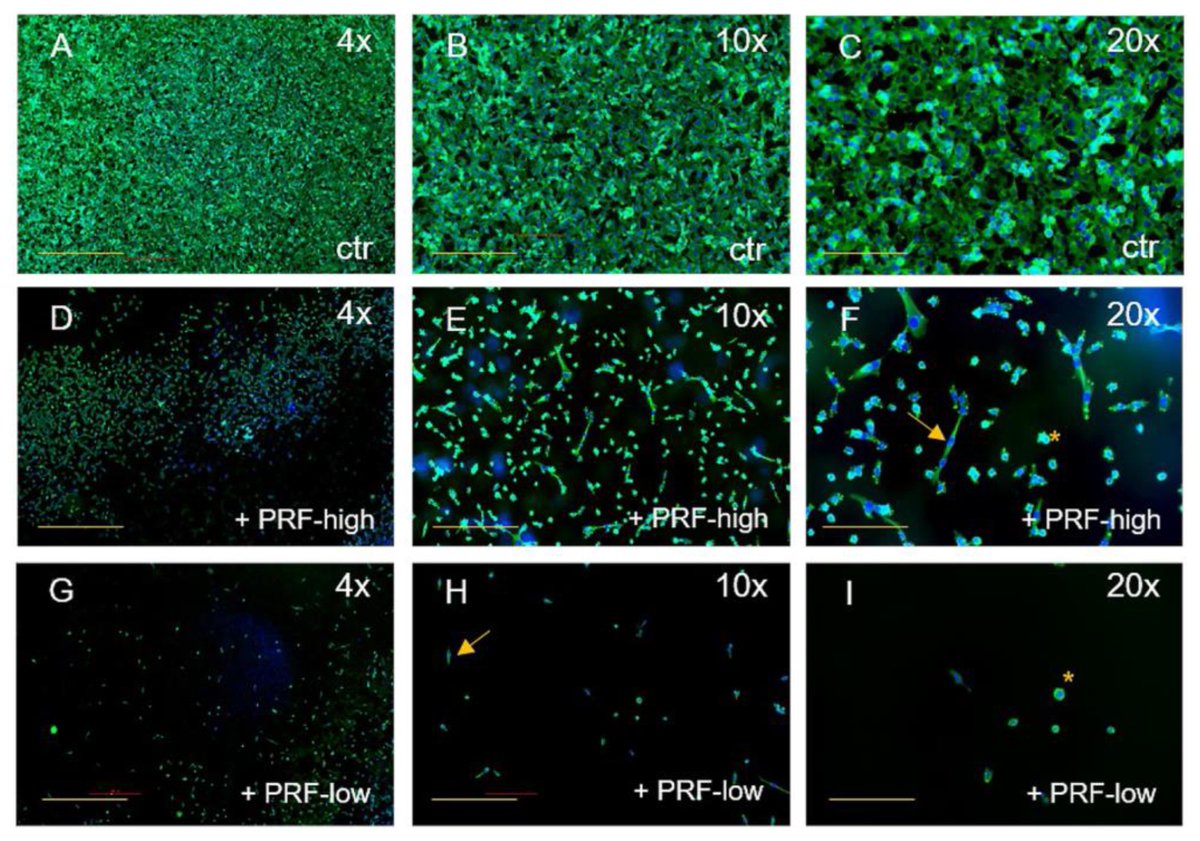 Bioeng_MDPI's tweet photo. 💥Highly recommended publication: "#Immunomodulation of #Cancer Cells Using #Autologous #Blood #Concentrates as a Patient-Specific Cell Culture System: A Comparative Study on #Osteosarcoma and #Fibrosarcoma Cell Lines"
🔗 https://t.co/iOuD0kuiXM
🏫 @goetheuni @UMG_Tweet https://t.co/IYcXhSAYId