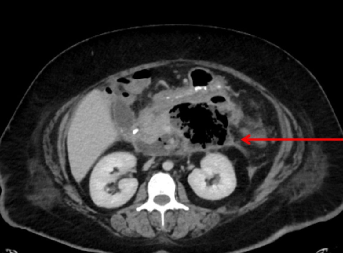 Derby Pancreaticobiliary & Robotic AWR Unit tweet media