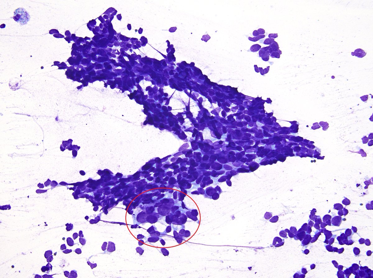 sza_jhcyto's tweet photo. Extremely rare case of a thyroid FNA in a patient with a history of Alk+ lung adenocarcinoma. An earlier FNA of the adrenal gland showed a mixed small cell-adenocarcinoma with both components staining with TTF-1. The thyroid FNA was predominantly small cell carcinoma with a minute component of adenocarcinoma (red circle) c/w patient's known lung primary.