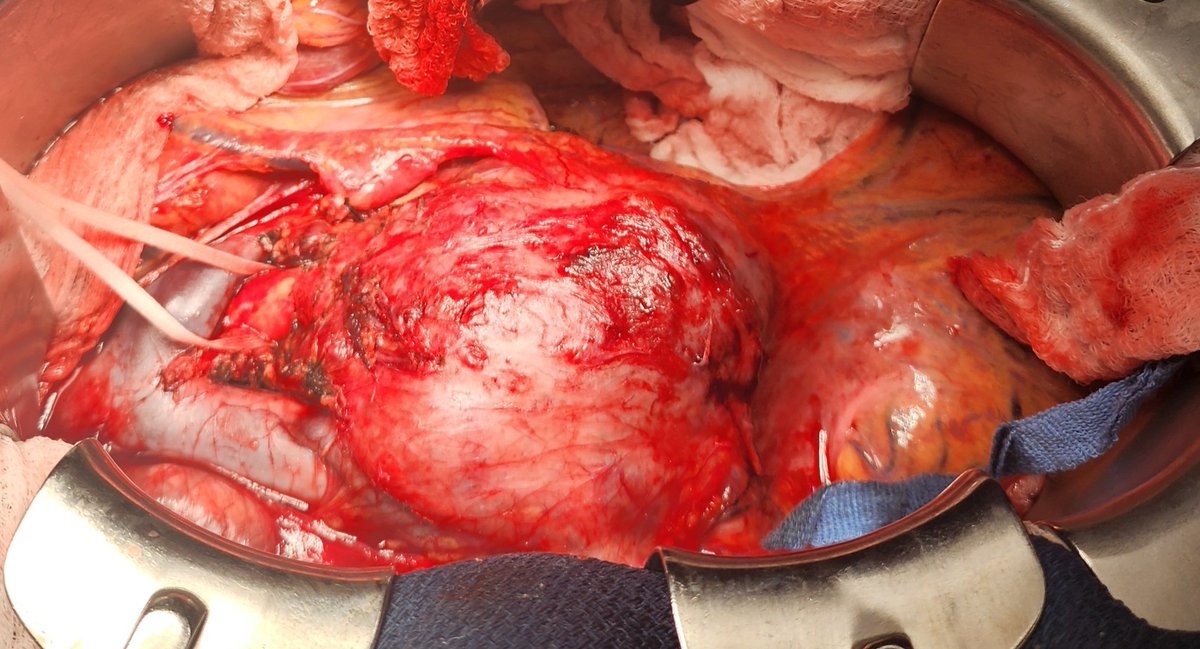 MaherSabalbal's tweet photo. Ruptured Mycotic aneurysm initially repaired endo to stabilize, followed 2 weeks later with en bloc resection of the aorta and stent grafts + cadaveric aorta to reconstruct. #Inthebucket @farkomd @canuc_57 @AmputationSuck @CanadianSVS @ReneLizola https://t.co/9tJPiklMp0