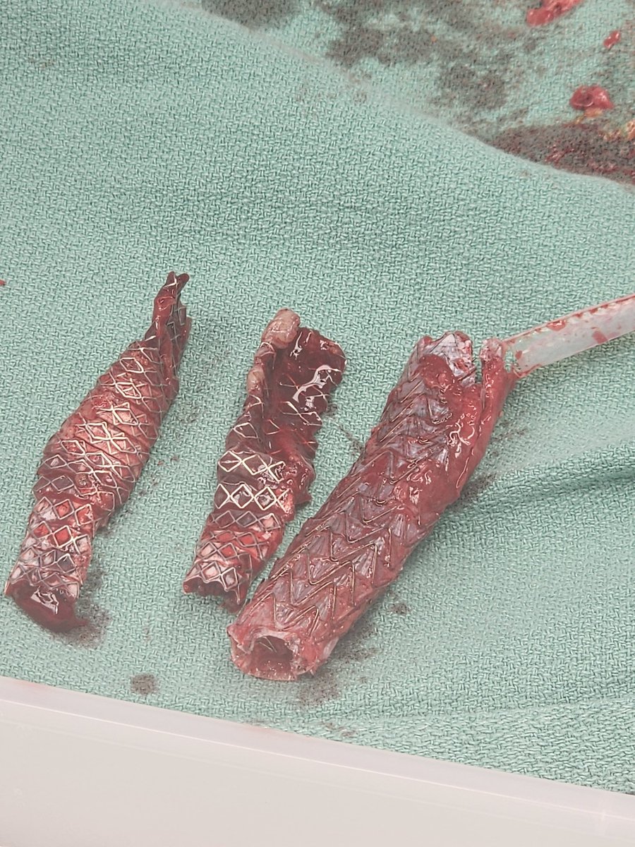 MaherSabalbal's tweet photo. Ruptured Mycotic aneurysm initially repaired endo to stabilize, followed 2 weeks later with en bloc resection of the aorta and stent grafts + cadaveric aorta to reconstruct. #Inthebucket @farkomd @canuc_57 @AmputationSuck @CanadianSVS @ReneLizola https://t.co/9tJPiklMp0