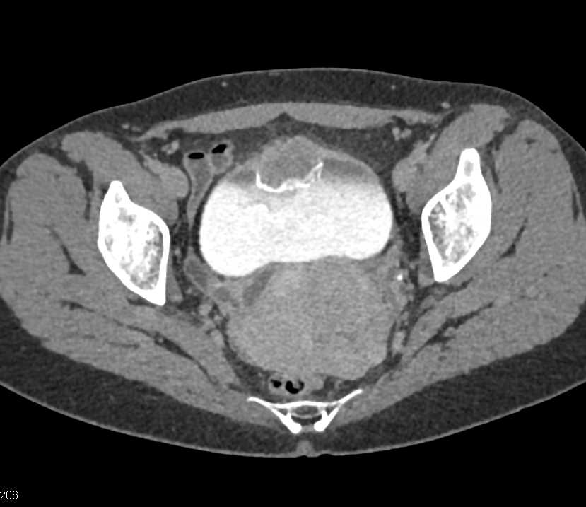 ctisus's tweet photo. Urachal Carcinoma of the Bladder: https://t.co/sSJWQurDnD https://t.co/IiRY4HTbIk
