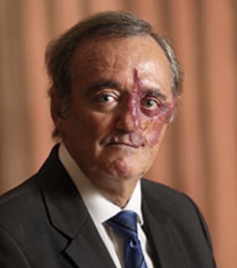 2StefanMoore's tweet image. Breaking news in #PancreaticCancer research! 

Spanish oncologist Mariano Barbacid’s team at CNIO just achieved complete regression of KRAS mutated pancreatic tumors in mice using a low toxicity drug combo, RMC-6236 (KRAS inhibitor), afatinib (EGFR inhibitor) &amp;amp; SD36 (STAT3…