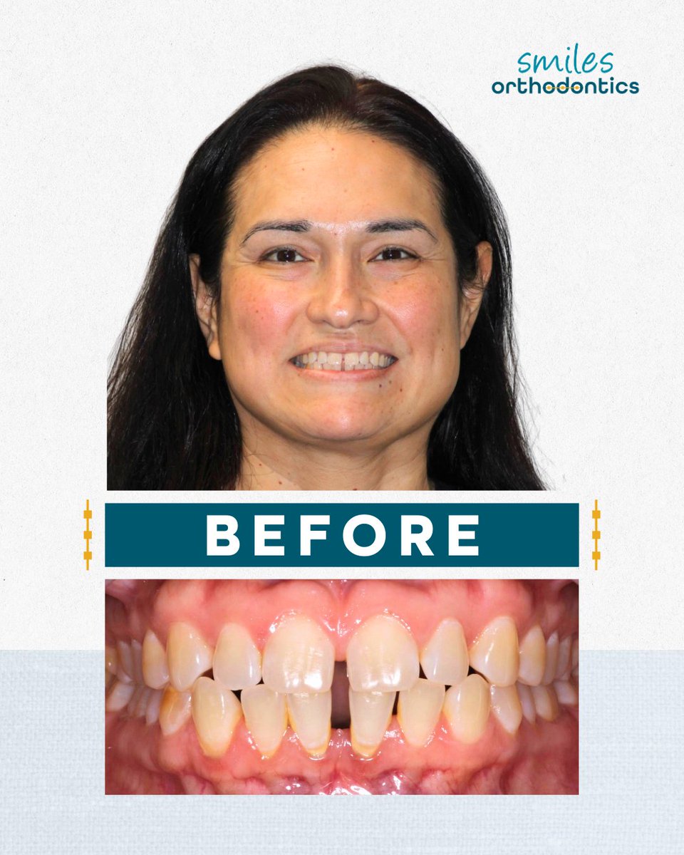 smilesortho's tweet image. Jessica has officially completed her orthodontic treatment and got her braces off! 🎉 Congratulations on your beautiful new smile! 😁✨

➡️ Swipe to see her amazing before-and-after transformation. 

#SmileTransformation #OrthodonticTreatment #Braces #SmilesOrthodontics