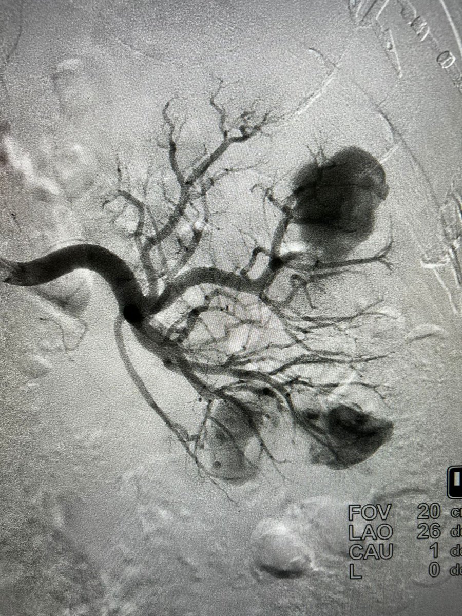 dr_khadgi's tweet photo. Very interesting case to share- 70/m with h/o PCNL and pyelolithotomy underwent Mini PCNL for multiple residual renal stones. Highly vascular anatomy with multiple punctures developed hematuria. Angio pic https://t.co/uayat4VYhB