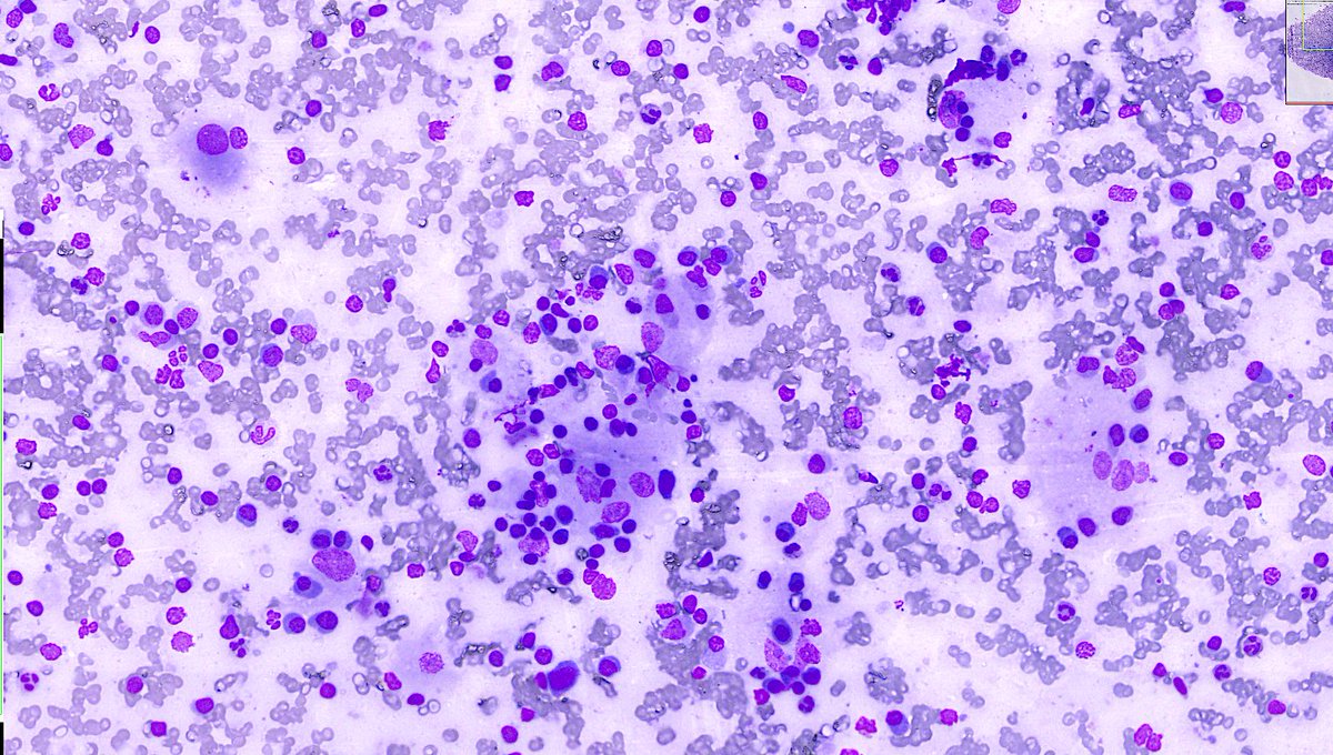 SumantaDas_7's tweet photo. Young patient. Cervical lymphadenopathy. #PathX #PathTwitter #CytoHisto correlation #PathHistory https://t.co/b4GdZt8UpD