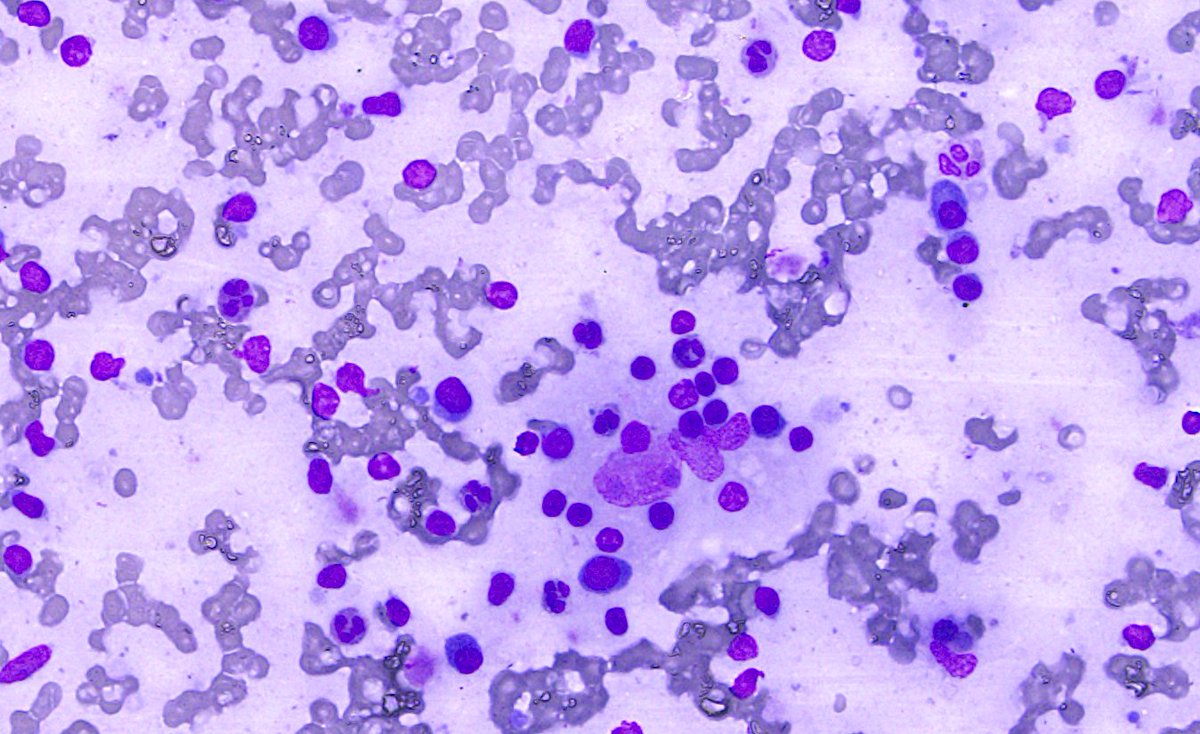 SumantaDas_7's tweet photo. Young patient. Cervical lymphadenopathy. #PathX #PathTwitter #CytoHisto correlation #PathHistory https://t.co/b4GdZt8UpD