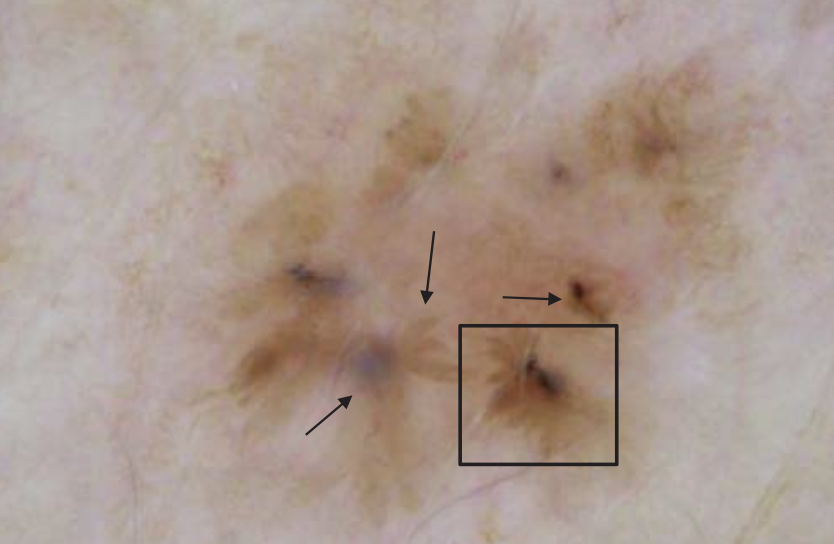 DermMarianne's tweet photo. 1⃣ Dermoscopic structure a day
🛞 Spoke-wheel structures
Well-defined pigmented radial projections converging toward a darker central globule.
Diagnostic for basal cell carcinoma
#dailyscope https://t.co/9OTOhQvFSe