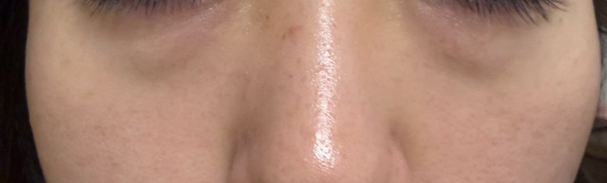 emmm_RI's tweet photo. ニキビ跡が若干薄くなってきたかな...？肌の調子は変わらず。また2週間後に品川行ってフォトシルク予定だから少しだけ期待しとこ。 https://t.co/joctgpdTk3