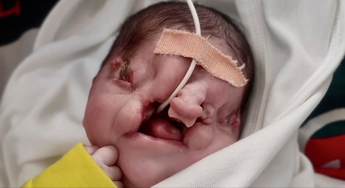 تفنيد ادعاءات الاحتلال بشأن المواليد ومحاولات نفي الإبادة

يتحدث الاحتلال عن 60,000 مولود في غزة خلال عام 2025، لا دفاعًا عن الحياة، بل في محاولة مكشوفة لنفي الإبادة الجماعية وإنكار استهداف الأطفال.
الحقيقة لا تُكتب بالدعاية، ولا تُبنى على أرقام مُفبركة، بل تُقرأ في بيانات صحية