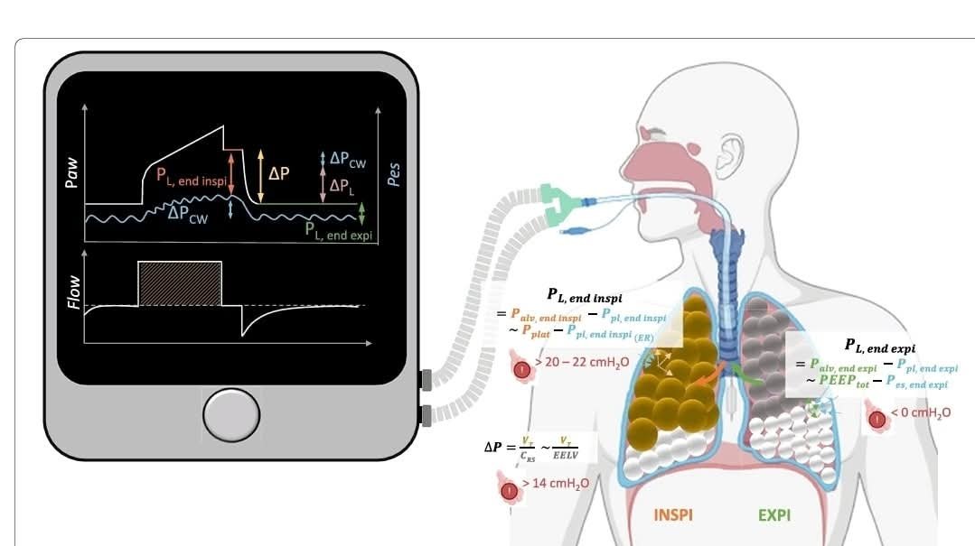 🔰Este artículo analiza de forma crítica dos conceptos centrales en la ventilación mecánica protectora: la presión de conducción (driving pressure, ΔP) y la presión transpulmonar (P_L). Aunque ambas se relacionan con la lesión pulmonar inducida por el ventilador (VILI),